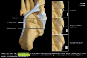 Accessory Navicular Types