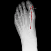Hallux Alignment - StatDx