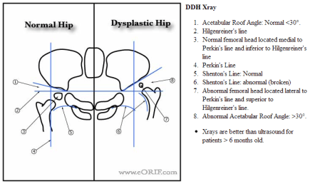Pediatric Hip Lines X-ray